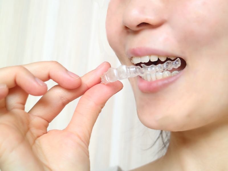 『invisalign』インビザライン矯正(マウスピース矯正)